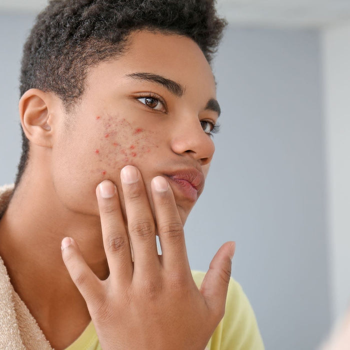 Teen boy looking in the mirror at some acne on his face.